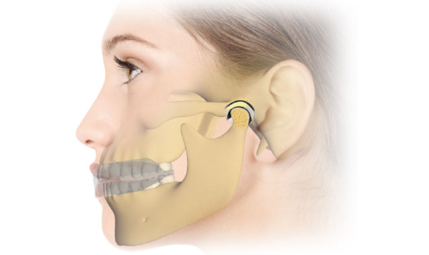 TMJ Splints & Orthotics Care